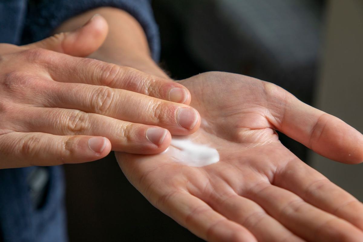 Emollient being applied to irritated skin on the hands